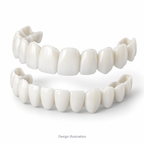 Design illustration of custom upper and lower veneers; not a photograph of the supplied product